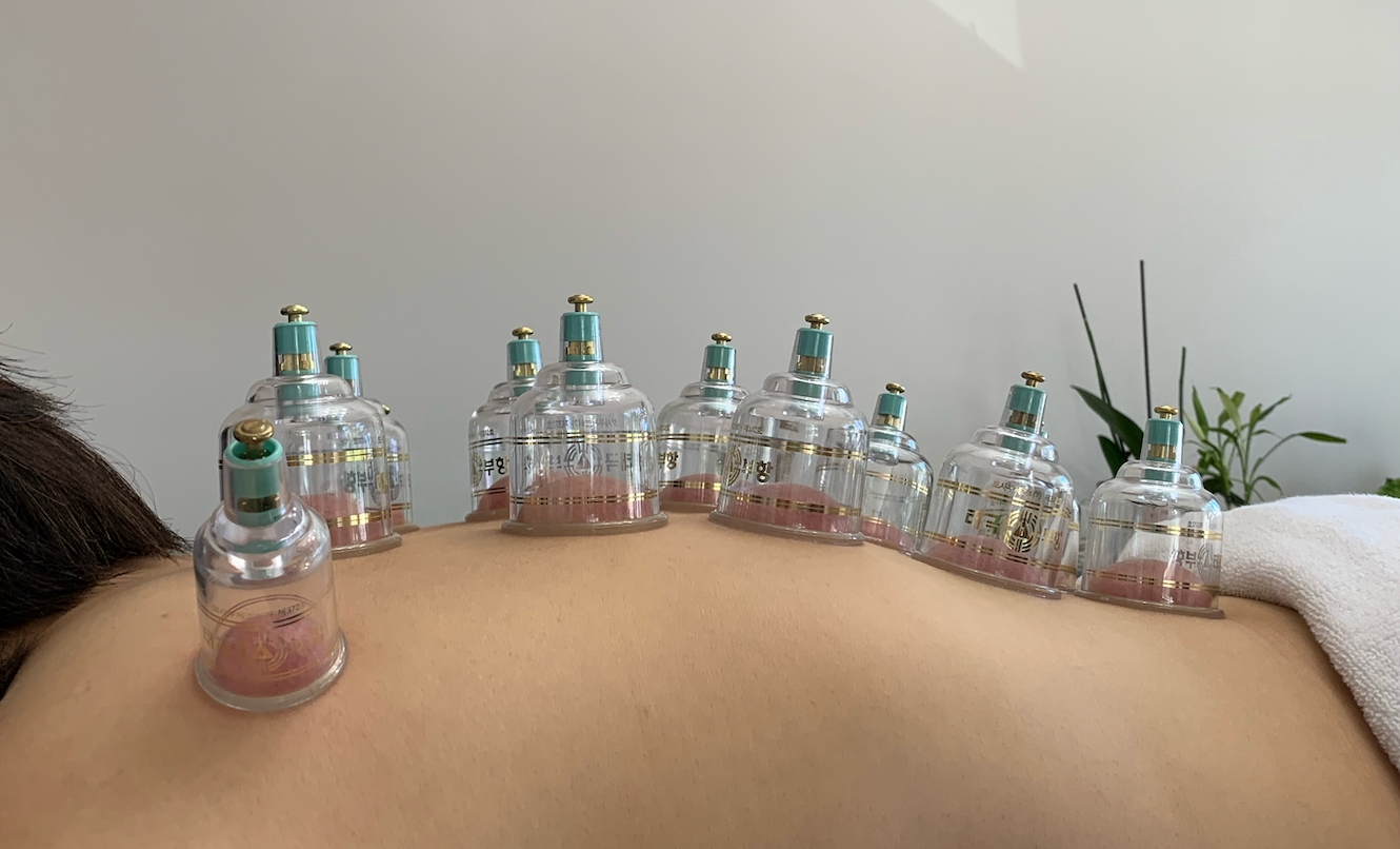 Cupping therapy setup.